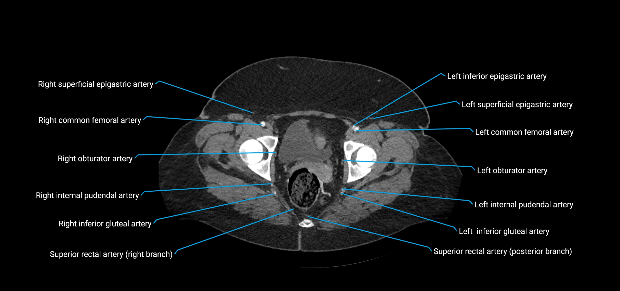CTA abdomen axial cross sectional anatomy labelled image_241 (1).webp